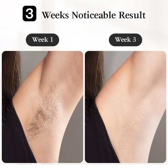 Laser Hair Removal - Picture 7 of 8